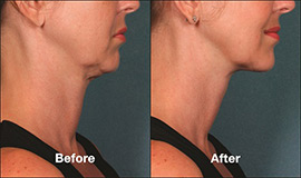 Kybella Before and After Pictures Indianapolis, IN
