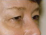 Blepharoplasty Before and After Pictures Indianapolis, IN