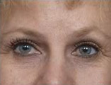 Blepharoplasty Before and After Pictures Indianapolis, IN