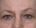 Blepharoplasty Before and After Pictures Indianapolis, IN