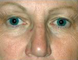 Blepharoplasty Before and After Pictures Indianapolis, IN