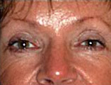 Blepharoplasty Before and After Pictures Indianapolis, IN