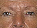 Blepharoplasty Before and After Pictures Indianapolis, IN