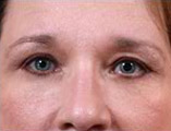 Blepharoplasty Before and After Pictures Indianapolis, IN