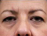 Blepharoplasty Before and After Pictures Indianapolis, IN