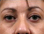 Blepharoplasty Before and After Pictures Indianapolis, IN