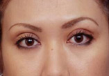 Blepharoplasty Before and After Pictures Indianapolis, IN