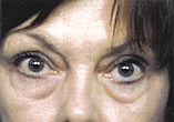 Blepharoplasty Before and After Pictures Indianapolis, IN