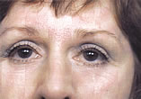 Blepharoplasty Before and After Pictures Indianapolis, IN