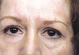 Blepharoplasty Before and After Pictures Indianapolis, IN