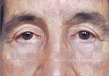 Blepharoplasty Before and After Pictures Indianapolis, IN