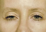 Blepharoplasty Before and After Pictures Indianapolis, IN