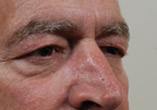 Blepharoplasty Before and After Pictures Indianapolis, IN