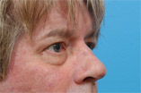 Blepharoplasty Before and After Pictures Indianapolis, IN