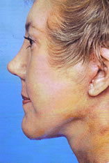 Facelift Before and After Pictures Indianapolis, IN