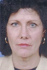 Facelift Before and After Pictures Indianapolis, IN