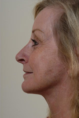 Facelift Before and After Pictures Indianapolis, IN