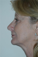 Facelift Before and After Pictures Indianapolis, IN