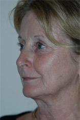 Facelift Before and After Pictures Indianapolis, IN