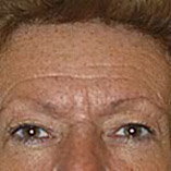 Brow Lift Before and After Pictures Indianapolis, IN