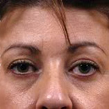 Brow Lift Before and After Pictures Indianapolis, IN