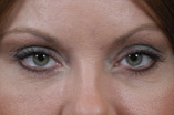 Blepharoplasty Before and After Pictures Indianapolis, IN