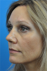 Brow Lift Before and After Pictures Indianapolis, IN