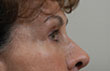 Blepharoplasty Before and After Pictures Indianapolis, IN