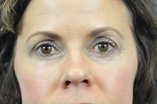 Blepharoplasty Before and After Pictures Indianapolis, IN