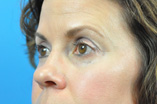 Blepharoplasty Before and After Pictures Indianapolis, IN