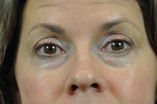 Blepharoplasty Before and After Pictures Indianapolis, IN