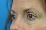 Blepharoplasty Before and After Pictures Indianapolis, IN