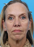 Facelift Before and After Pictures Indianapolis, IN