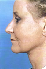 Facelift Before and After Pictures Indianapolis, IN