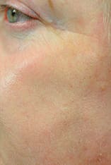 Fractional Laser Resurfacing Before and After Pictures Indianapolis, IN