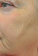 Fractional Laser Resurfacing Before and After Pictures Indianapolis, IN