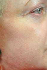 Fractional Laser Resurfacing Before and After Pictures Indianapolis, IN