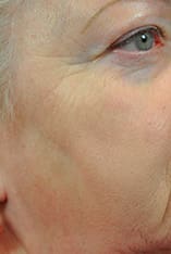 Fractional Laser Resurfacing Before and After Pictures Indianapolis, IN