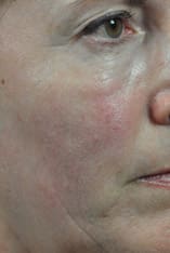 Fractional Laser Resurfacing Before and After Pictures Indianapolis, IN