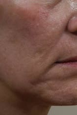 Fractional Laser Resurfacing Before and After Pictures Indianapolis, IN