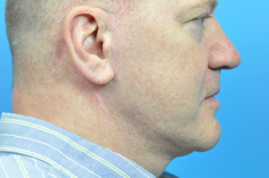 Rhinoplasty Before and After Pictures Indianapolis, IN