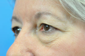 Blepharoplasty Before and After Pictures Indianapolis, IN