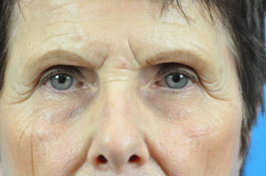 Facelift Before and After Pictures Indianapolis, IN